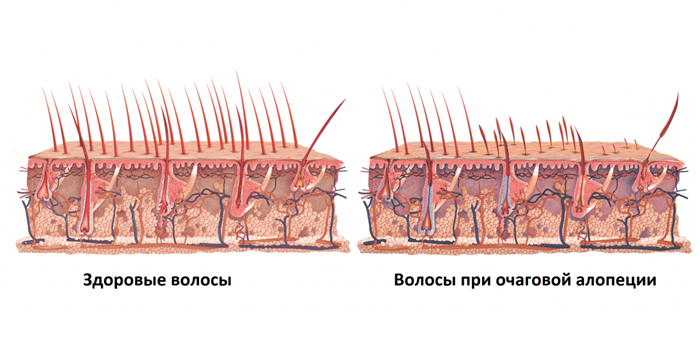 Алопеция ареата.png