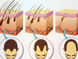 Самые распространенные причины выпадения волос у мужчин | MedAboutMe